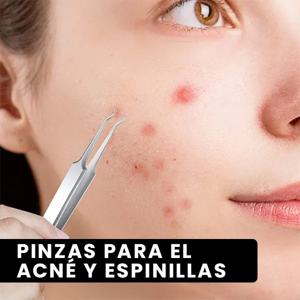 Pinzas para el Acné y Espinillas